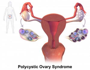 Diagram of polycystic ovary syndrome PCOS