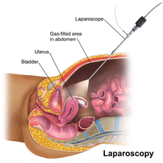 diagram of laparoscopy