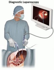 diagnostic laparoscopy