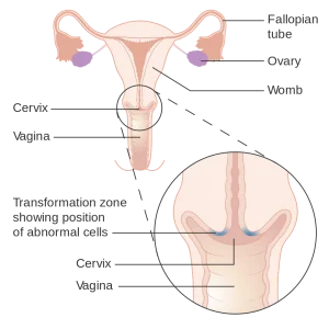 Diagram showing the cervical transformation zone