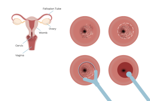 Leetz LLETZ Procedure – Safe and effective cervical cell treatment